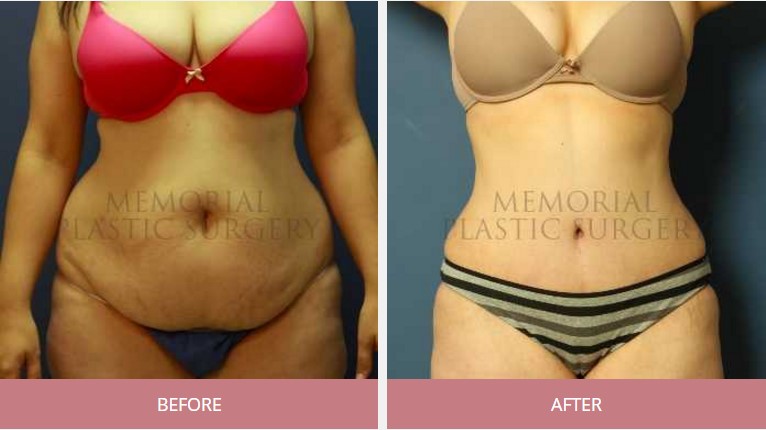 Tummy tuck patient before and after